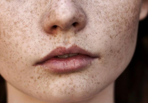 About Some Skin Spot Symptoms