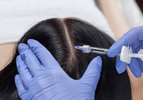 Mesotherapy For Hair Loss