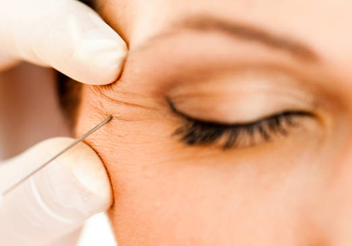 Information About Botox Injections
