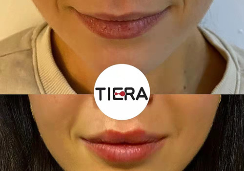 Lip Filler injection protocol from Dr. Carlos