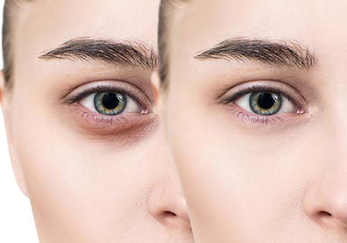 At-Home Treatments For Dark Eye Circles